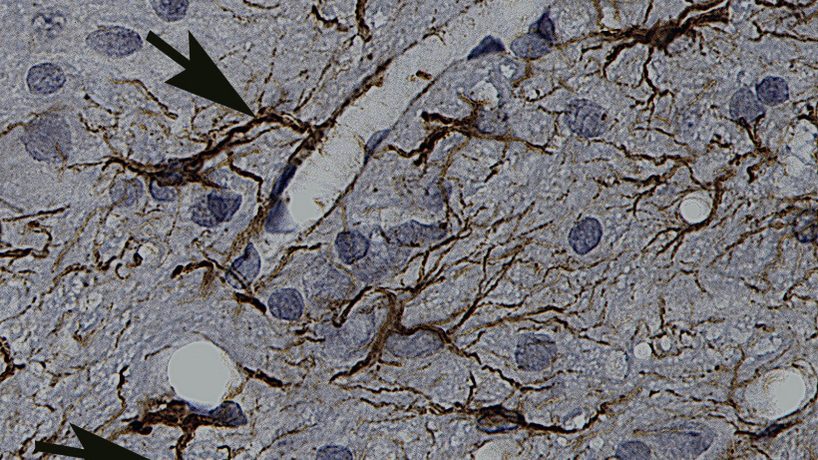 Therapeutic particle blocked by the CNS barrier