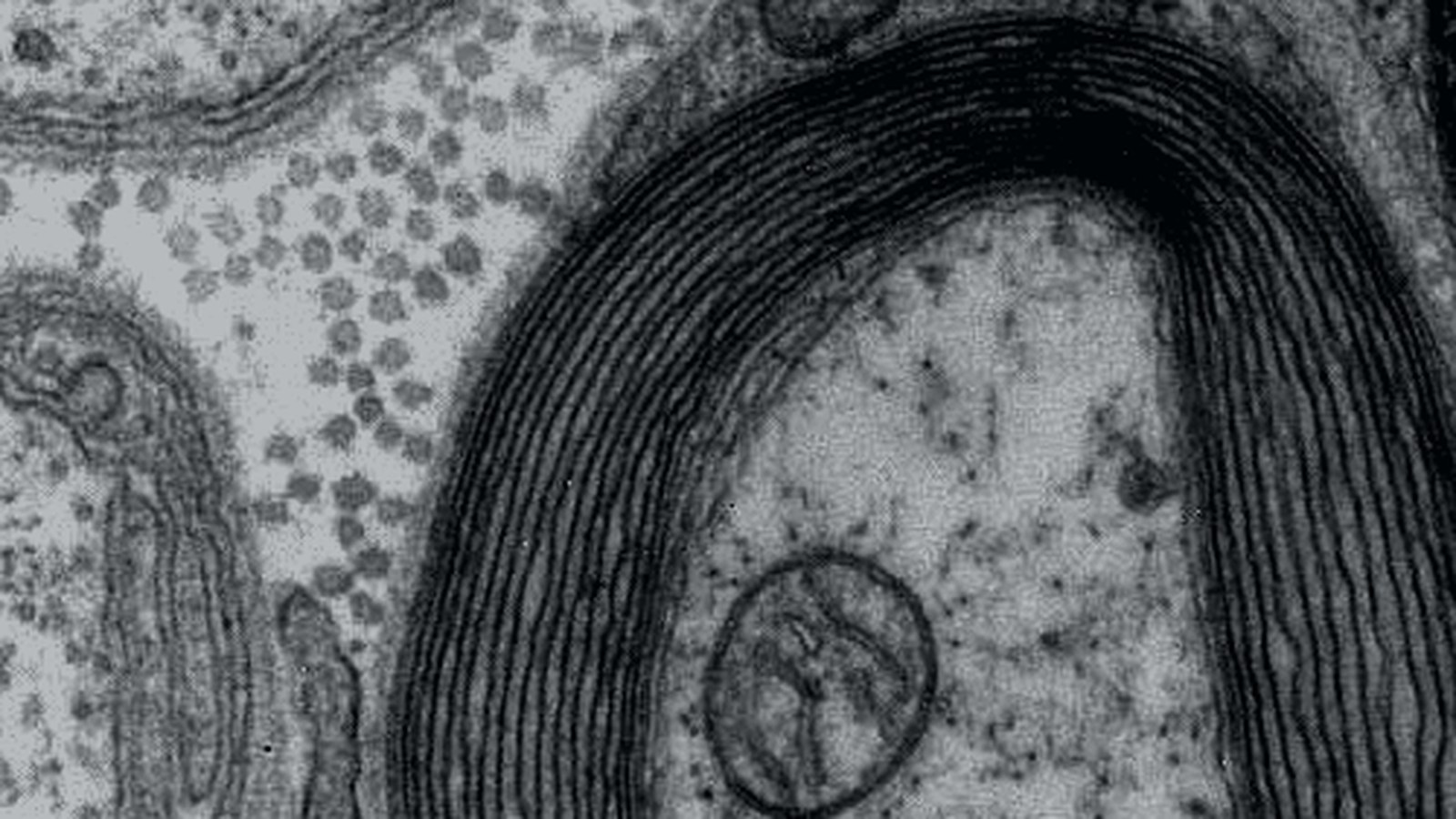 Damaged myelin around a nerve fiber